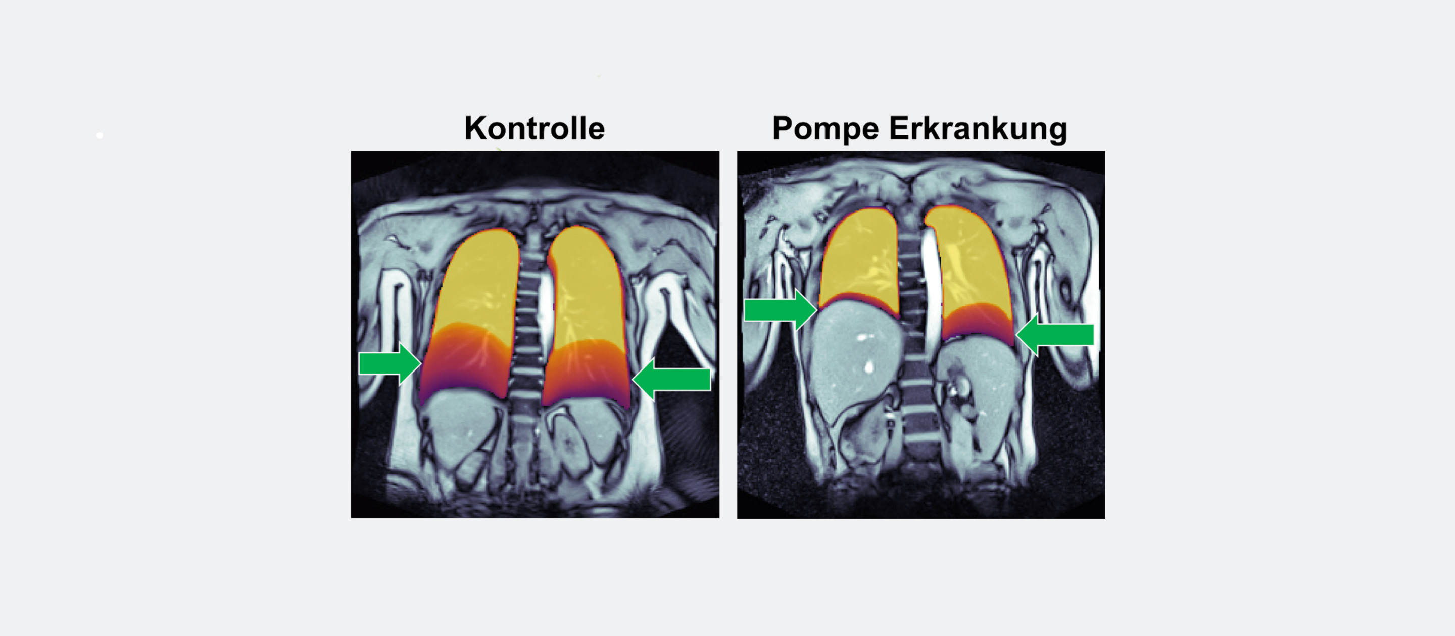 Links ist die Aufnahme eines gesunden Kontrollprobanden zu sehen, rechts die eines Patienten mit Morbus Pompe - Immanuel Klinik Rüdersdorf - Neurologie Links ist die Aufnahme eines gesunden Kontrollprobanden zu sehen, rechts die eines Patienten mit Morbus Pompe - Immanuel Klinik Rüdersdorf - Neurologie