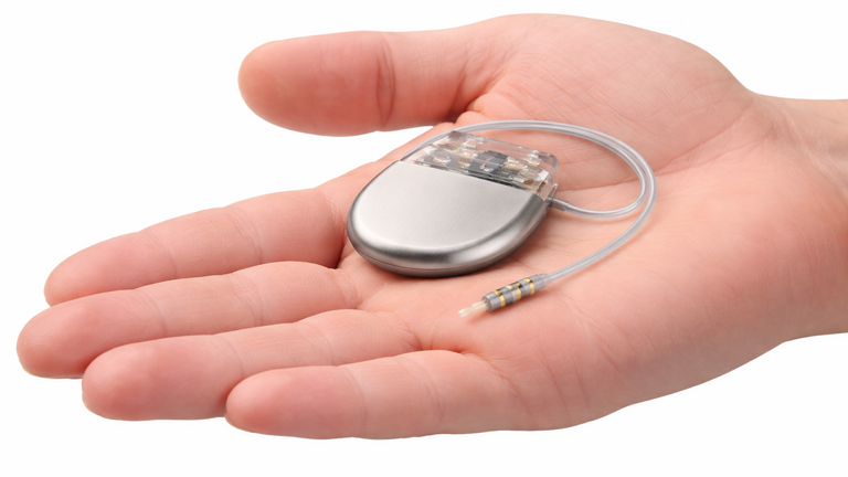 Beckenbodenschrittmacher zur sakralen Neuromodulation (SNS) als Implantat in einer Hand Beckenbodenschrittmacher zur sakralen Neuromodulation (SNS) als Implantat in einer Hand