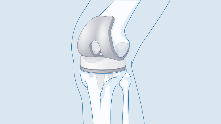 Grafik einer Knieprothese Erstversorgung