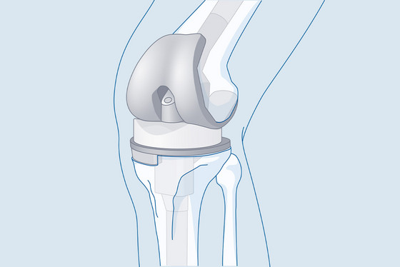 Grafik einer Knieprothese Revision