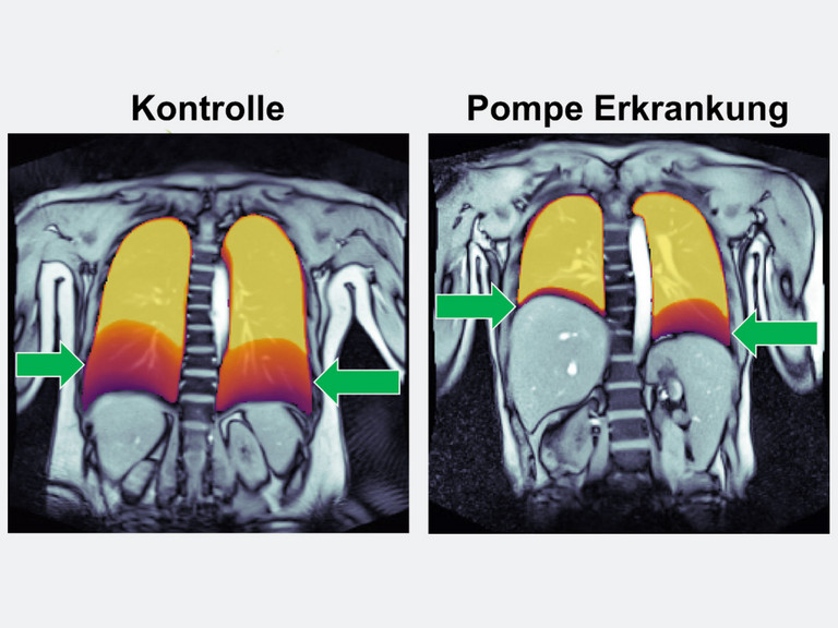 Links ist die Aufnahme eines gesunden Kontrollprobanden zu sehen, rechts die eines Patienten mit Morbus Pompe - Immanuel Klinik Rüdersdorf - Neurologie