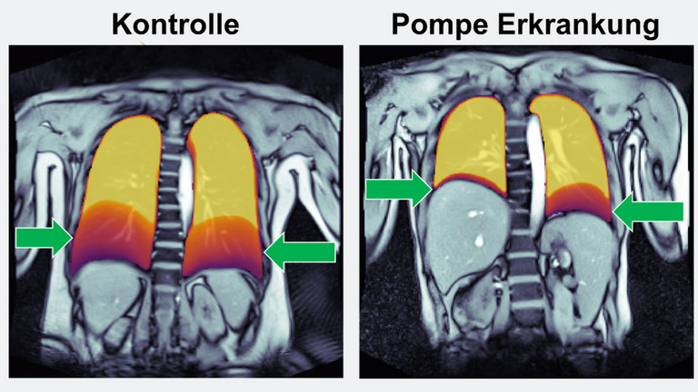 Links ist die Aufnahme eines gesunden Kontrollprobanden zu sehen, rechts die eines Patienten mit Morbus Pompe - Immanuel Klinik Rüdersdorf - Neurologie