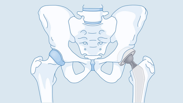 Grafik einer Hüftprothese